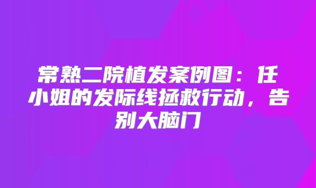 常熟二院植发案例图：任小姐的发际线拯救行动，告别大脑门